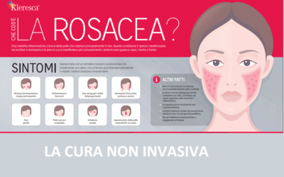 Trattamento Rosacea Kleresca®: terapia non invasiva per una patologia che colpisce oltre 415 milioni di persone